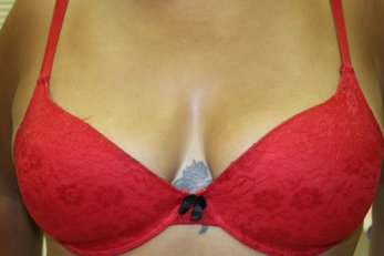 Vampire Breast Lift 1 - Before Treatment